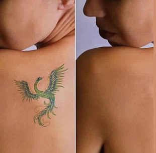 Tatoo Removal Laser treatment in Nagercoil